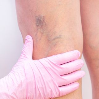 Prevenzione delle vene varicose